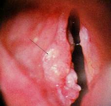 Throat Cancer Pictures