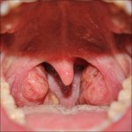 Throat Cancer Pictures